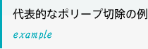 代表的なポリープ切除の例exsample